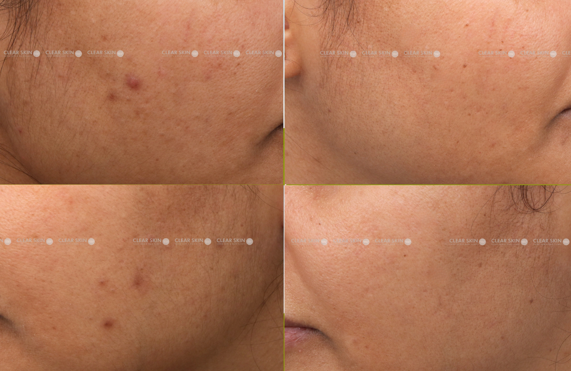 DPN Removal Treatment In Pune Clear Skin, Pune
