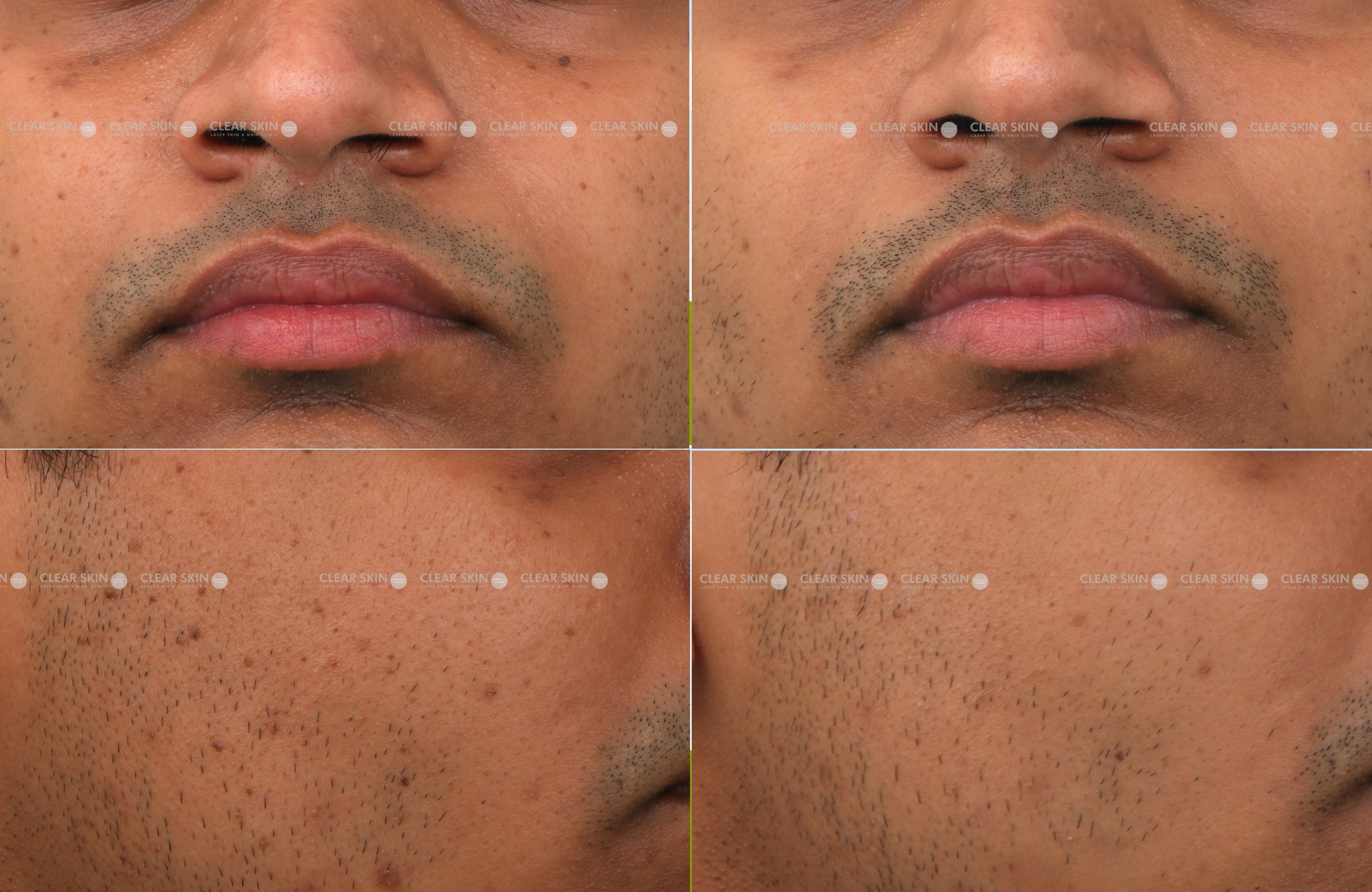 DPN Results 5 Months Timeline 4 Sessions Clear Skin Pune 2