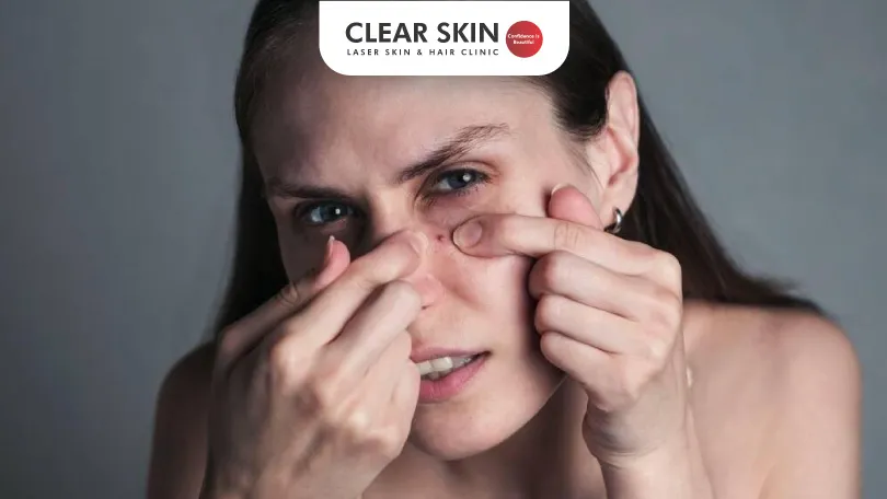 How to Get Rid of Pimples Clear Skin Pune