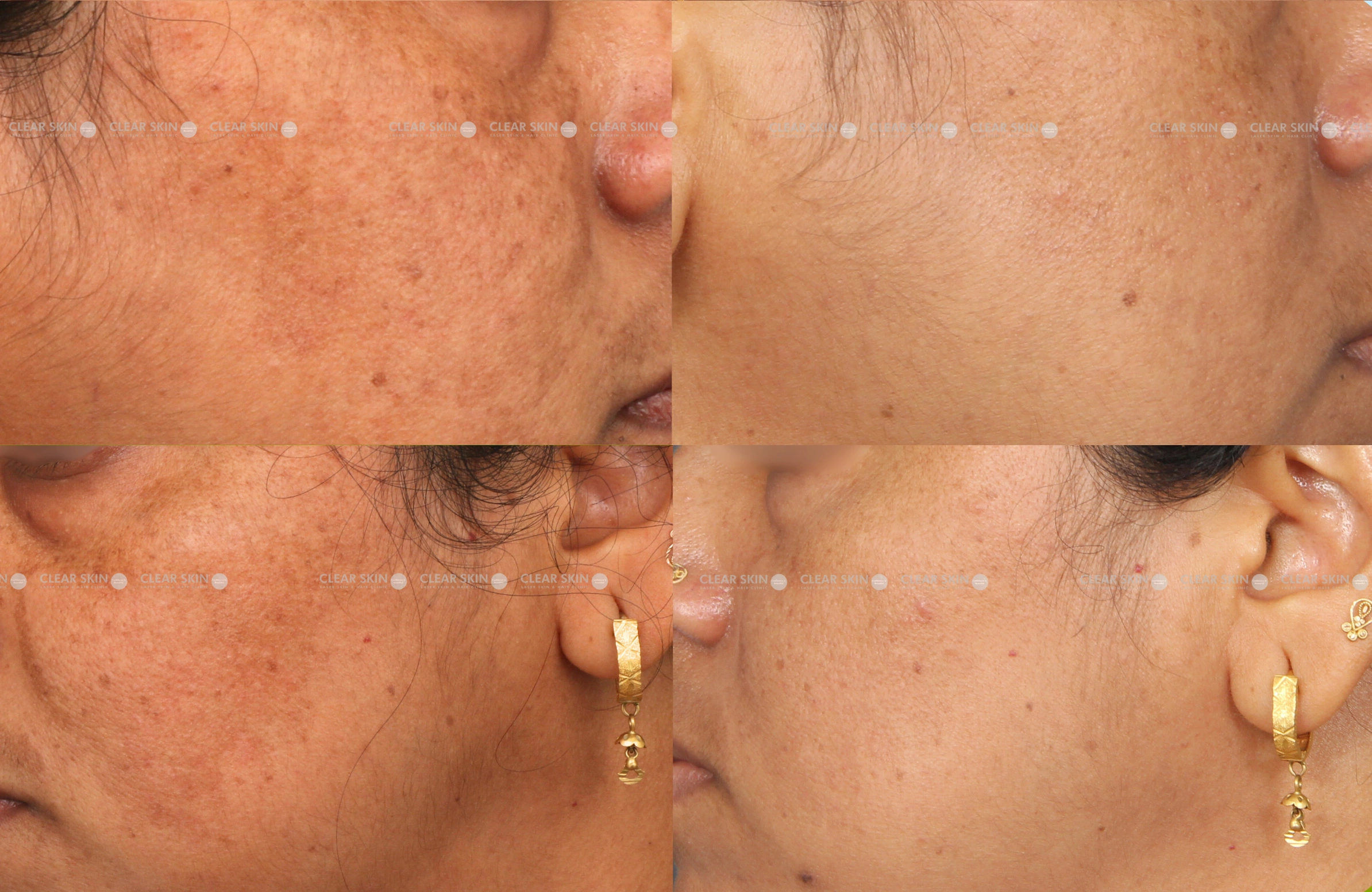 Melasma Results 5 Months Timeline 4 Sessions Clear Skin Pune