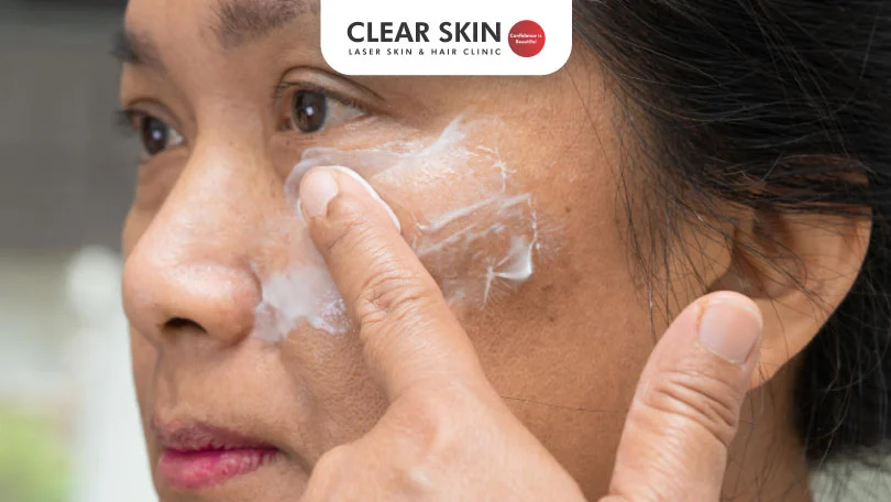 Natural-Remedies-for-Removing-Melasma-and-Blackness-Around-Mouth-Clear-Skin-Pune Natural Remedies for Removing Melasma and Blackness Around Mouth Clear Skin Pune