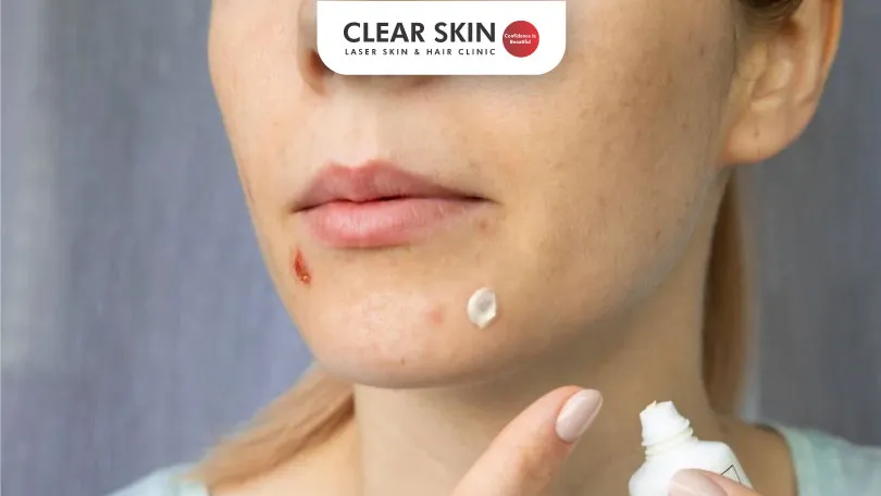 Tips to Choose the Best Moisturizers for Acne Prone Skin Clear Skin Pune