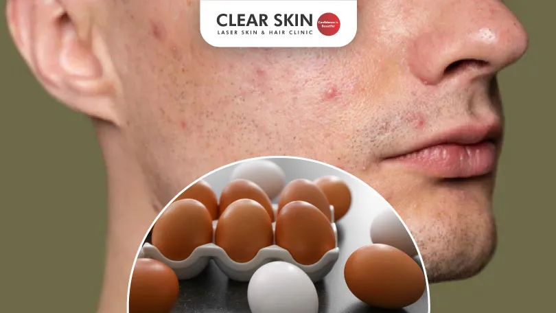 Unraveling-the-Egg-Acne-Connection-Clear-Skin-Pune Unravelling the Egg Acne Connection Clear Skin Pune