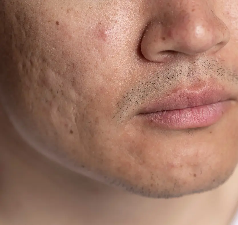 acne scars treatment pune