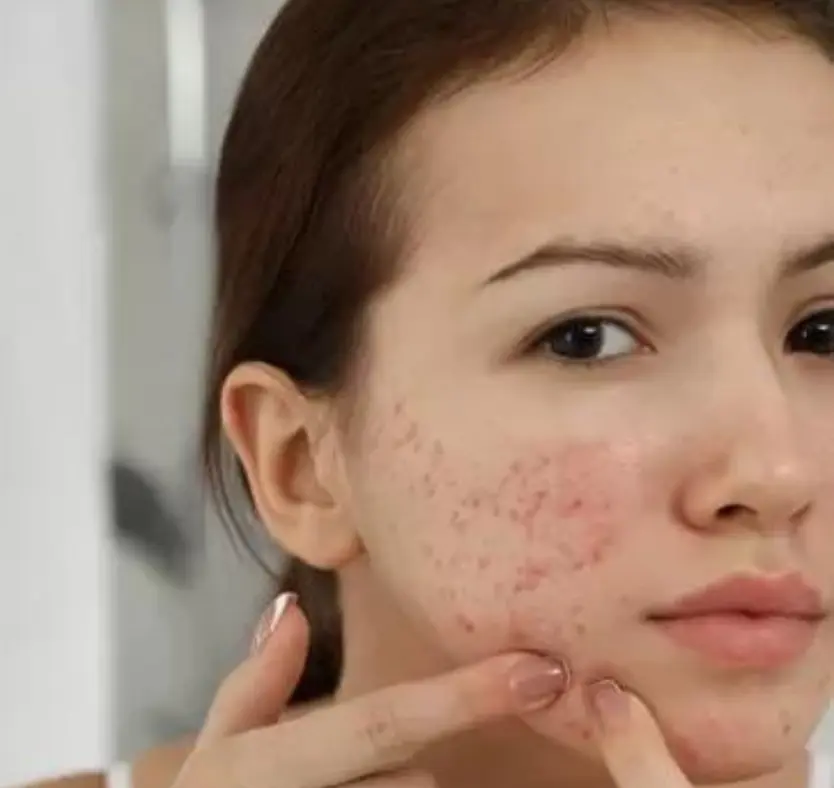 acne/pimples treatment pune