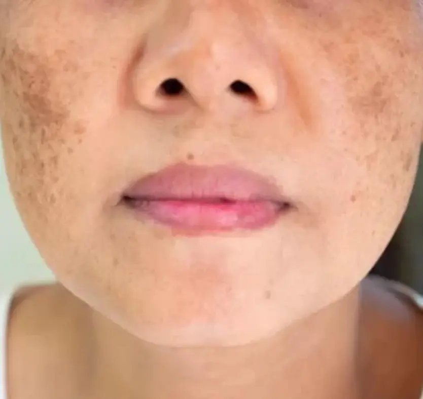 melasma treatment in pune