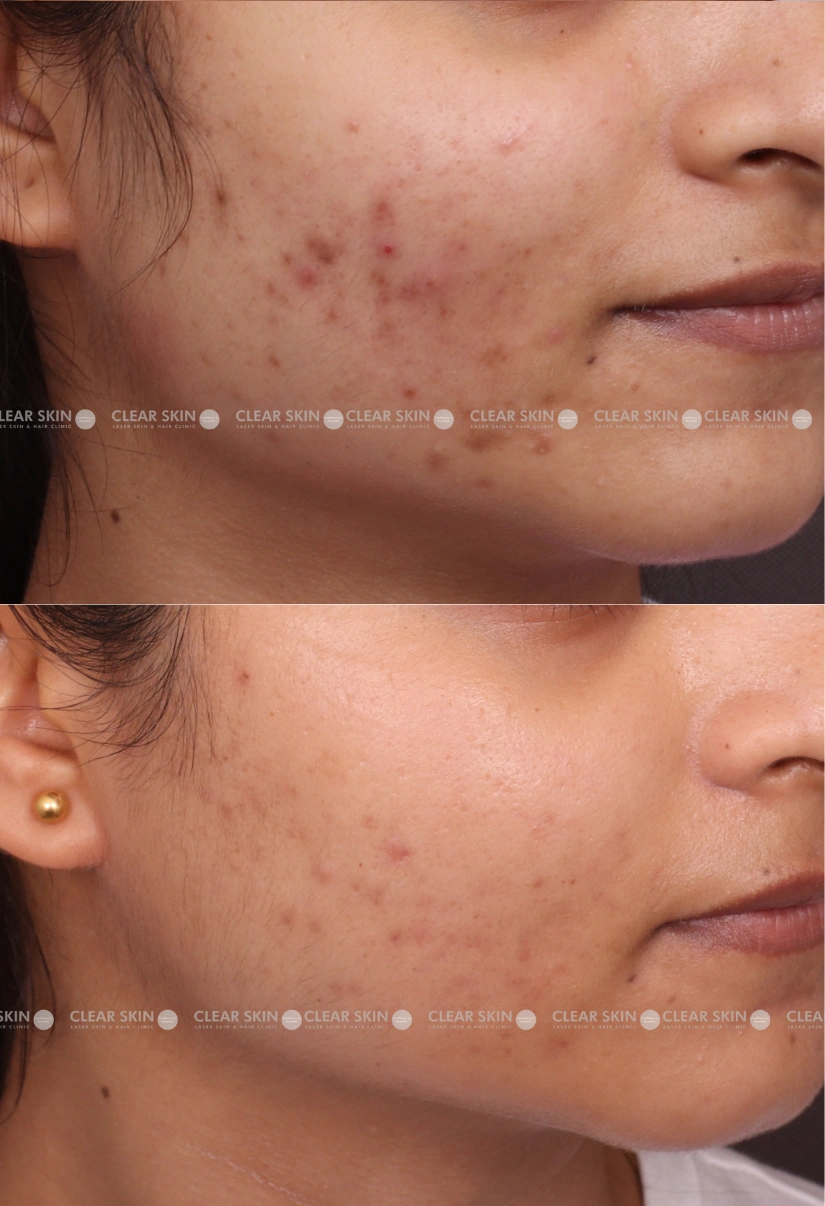 20yrs Female Chicken Pox Scar Results 5 Months Timeline 5 Sessions ClearSkin Pune