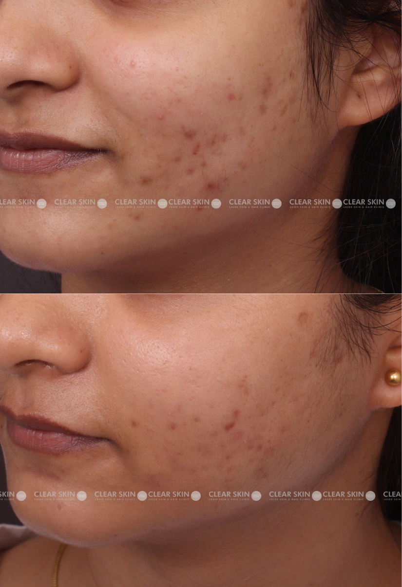 20yrs Female Chicken Pox Scar Results 5 Months Timeline 5 Sessions ClearSkin Pune (3)