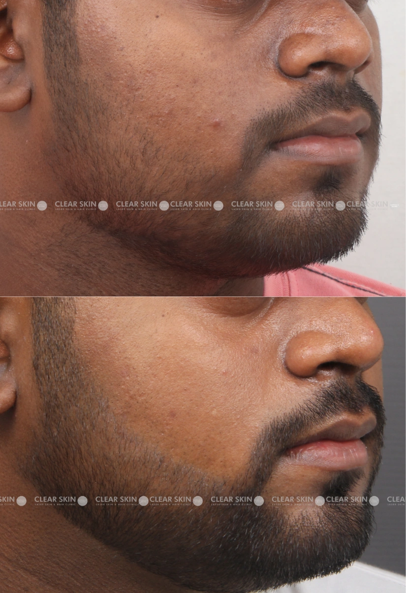 28yrs Male Skin Rejuvenation Results 5 Months Timeline 4 Sessions ClearSkin Pune