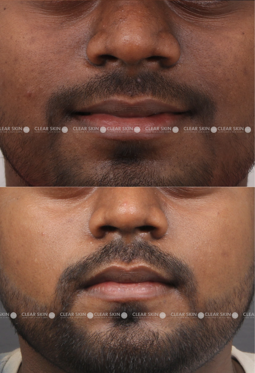 28yrs Male Skin Rejuvenation Results 5 Months Timeline 4 Sessions ClearSkin Pune