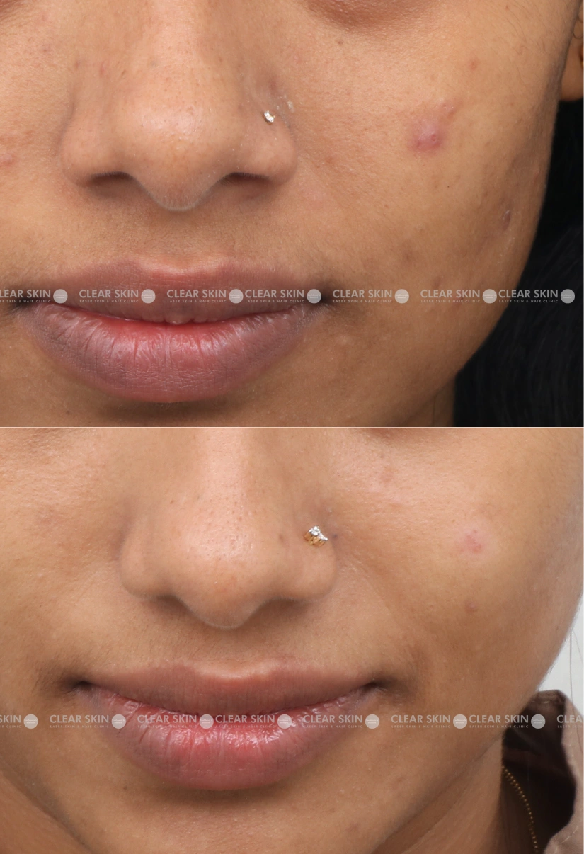 29yrs Female Chicken Pox Scar Results 6 Months Timeline 7 Sessions ClearSkin Pune