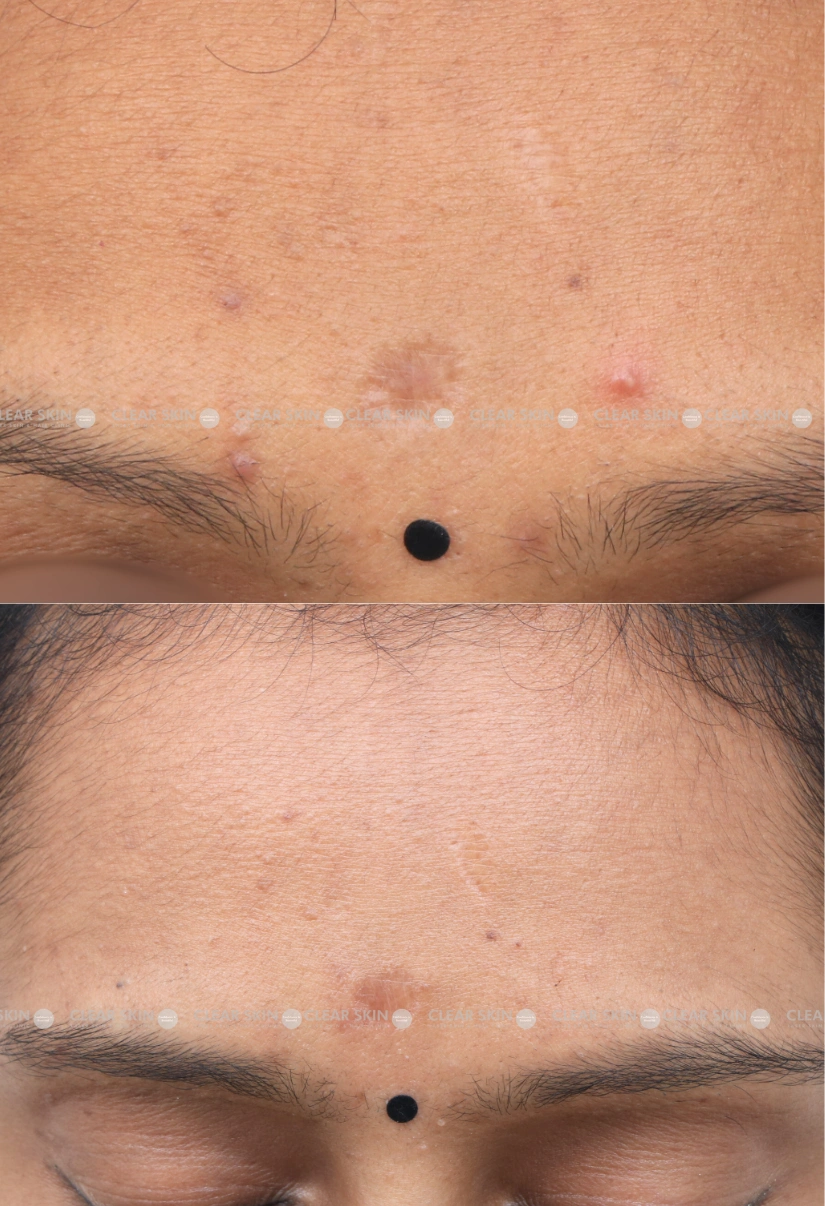 29yrs Female Chicken Pox Scar Results 6 Months Timeline 7 Sessions ClearSkin Pune