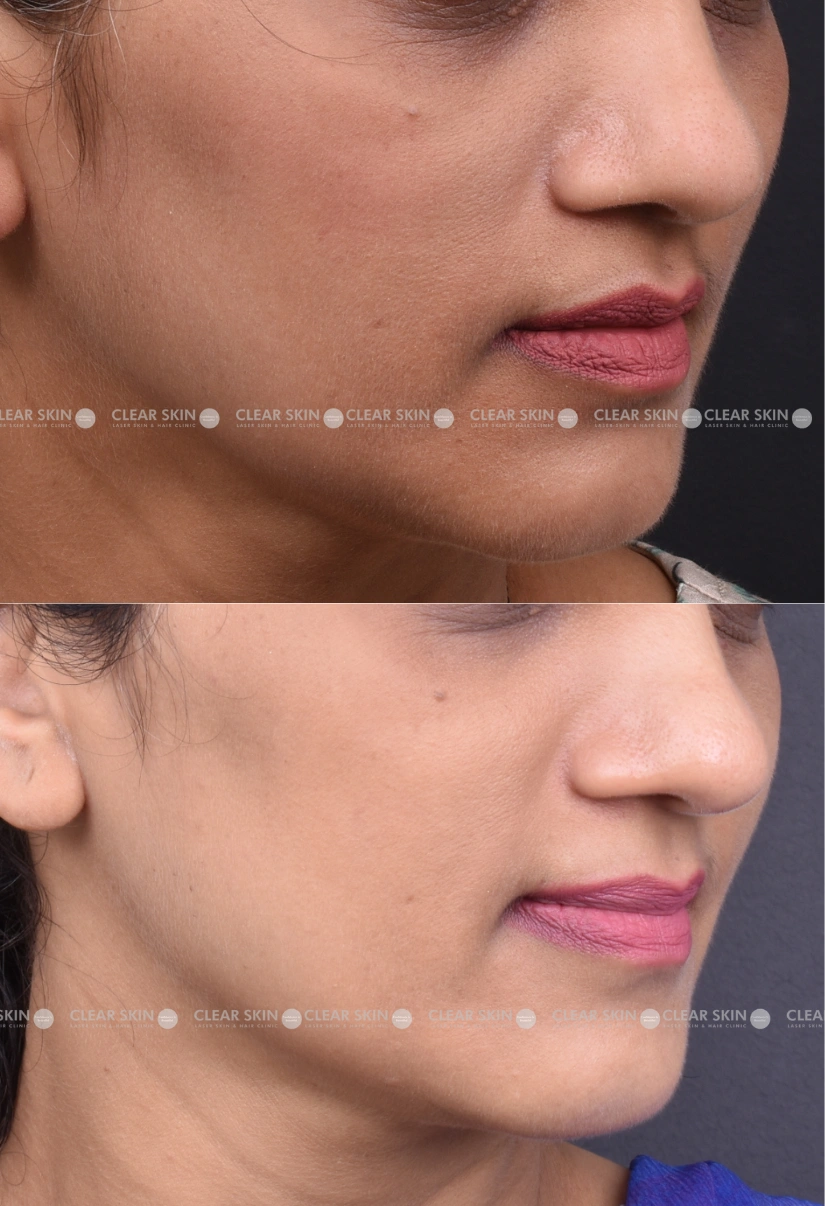 30yrs Female Skin Rejuvenation Results 2 Months Timeline 2 Sessions ClearSkin Pune