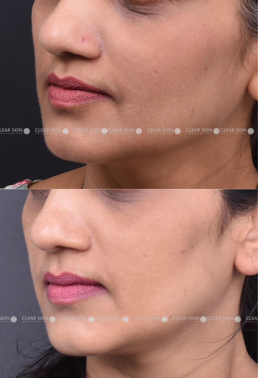 30yrs Female Skin Rejuvenation Results 2 Months Timeline 2 Sessions ClearSkin Pune