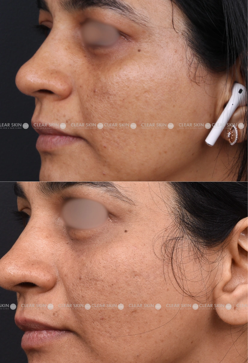 30yrs Female Skin Rejuvenation Results 6 Months Timeline 6 Sessions ClearSkin Pune