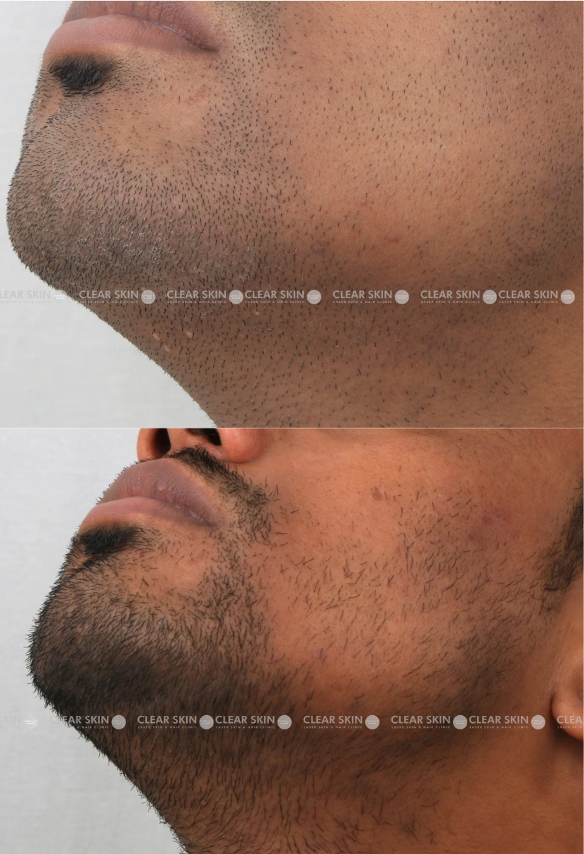 30yrs Female Mollusum Results 3 Months Timeline 2 Sessions ClearSkin Pune 3
