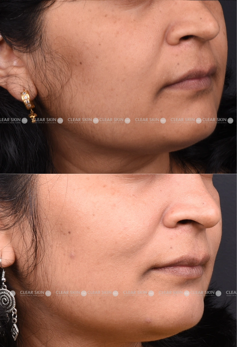 32yrs Female Skin Rejuvenation Results 4 Months Timeline 4 Sessions ClearSkin Pune