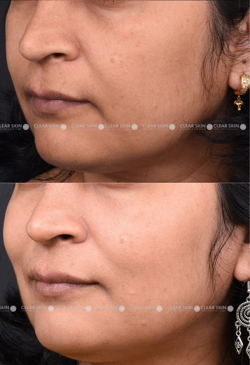 32yrs Female Skin Rejuvenation Results 4 Months Timeline 4 Sessions ClearSkin Pune