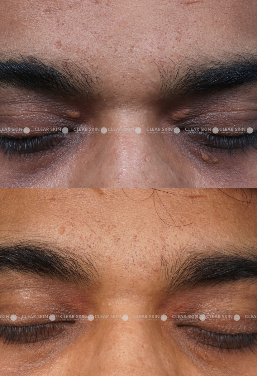 34yrs male Xanthalasma Results 1 Months Timeline 1 Sessions ClearSkin Pune (2)