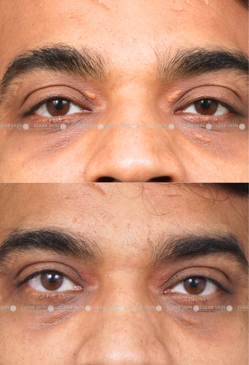 34yrs male Xanthalasma Results 1 Months Timeline 1 Sessions ClearSkin Pune