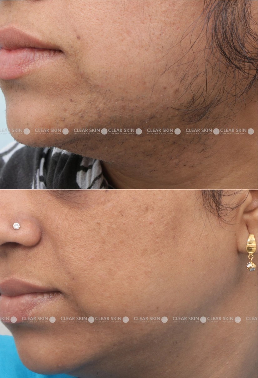 36yrs Female LHR Results 3 Months Timeline 3 Sessions ClearSkin Pune-3 (2)