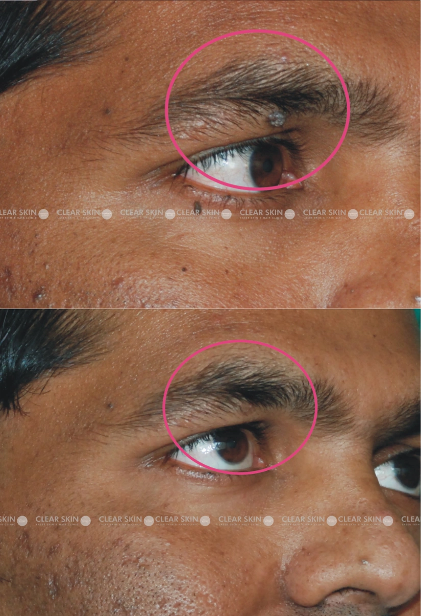 36yrs male Wart Removal Results 1 Months Timeline 1 Sessions ClearSkin Pune