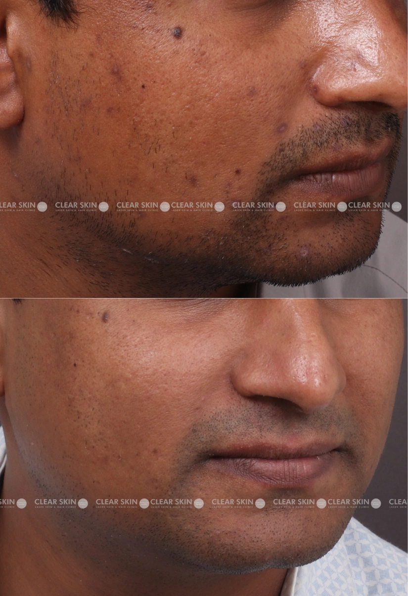 37yrs male Chicken Pox Scar Results 4 Months Timeline 4 Sessions ClearSkin Pune (2)