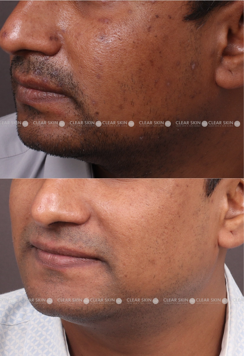 37yrs male Chicken Pox Scar Results 4 Months Timeline 4 Sessions ClearSkin Pune (3)