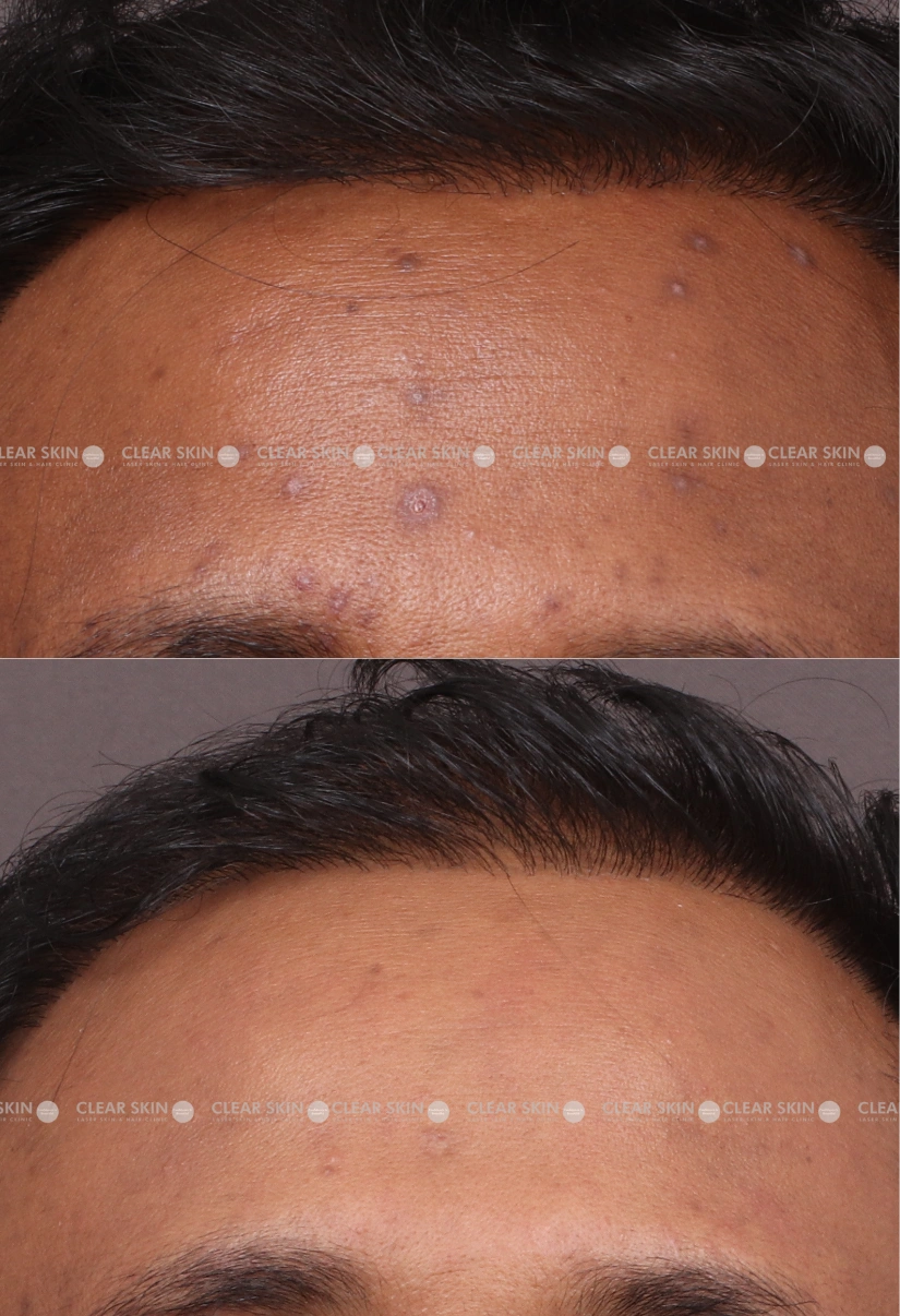 37yrs male Chicken Pox Scar Results 4 Months Timeline 4 Sessions ClearSkin Pune
