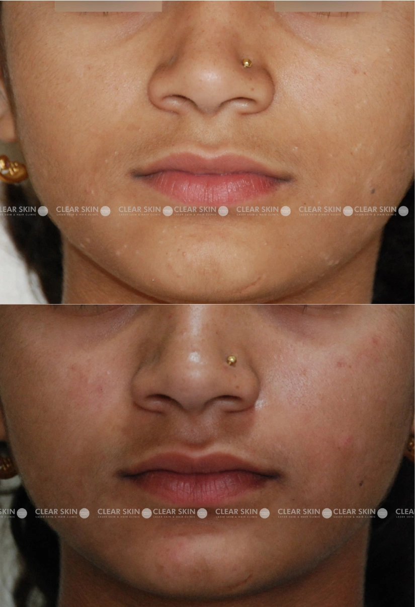 30yrs Female Mollusum Results 3 Months Timeline 2 Sessions ClearSkin Pune