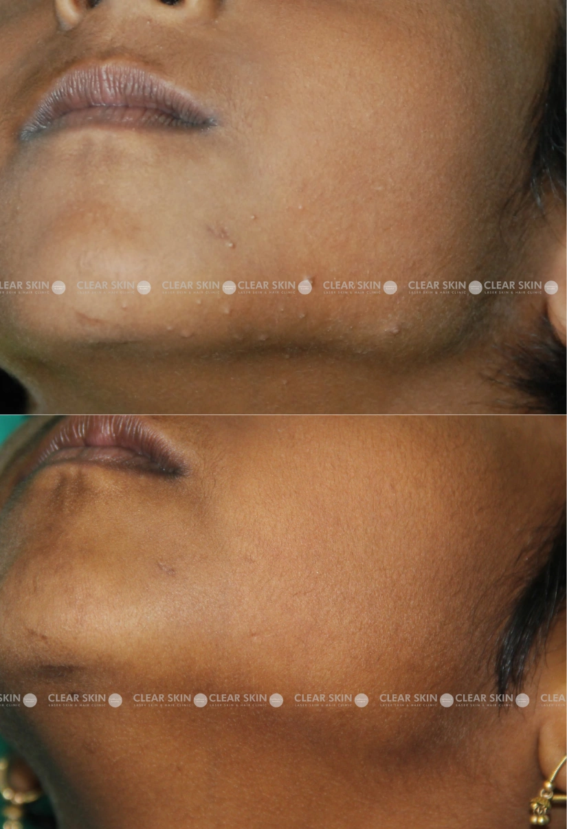 30yrs Female Mollusum Results 3 Months Timeline 2 Sessions ClearSkin Pune