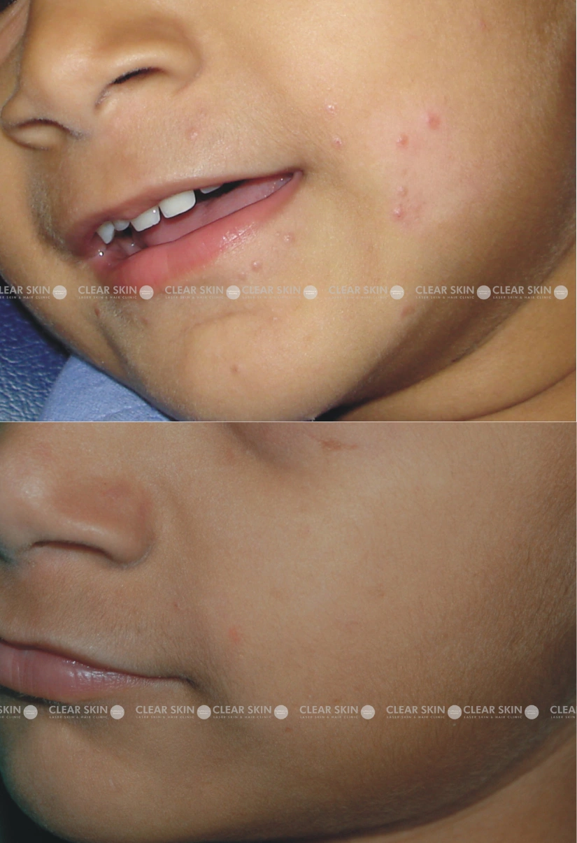 3yrs male Mollusum Results 3 Months Timeline 3 Sessions ClearSkin Pune