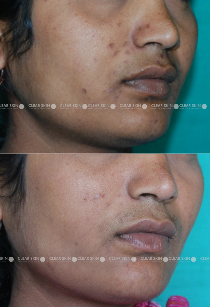 40yrs Female Chicken Pox Scar Results 5 Months Timeline 4 Sessions ClearSkin Pune