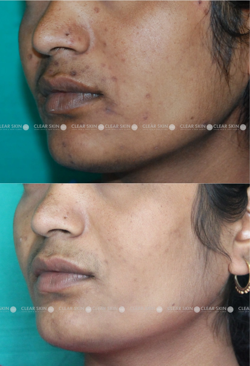 40yrs Female Chicken Pox Scar Results 5 Months Timeline 4 Sessions ClearSkin Pune