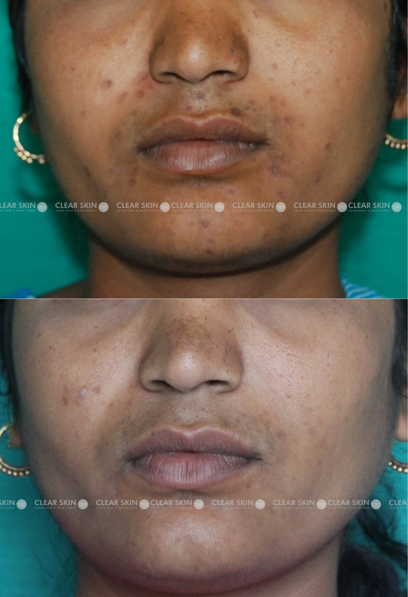 40yrs Female Chicken Pox Scar Results 5 Months Timeline 4 Sessions ClearSkin Pune