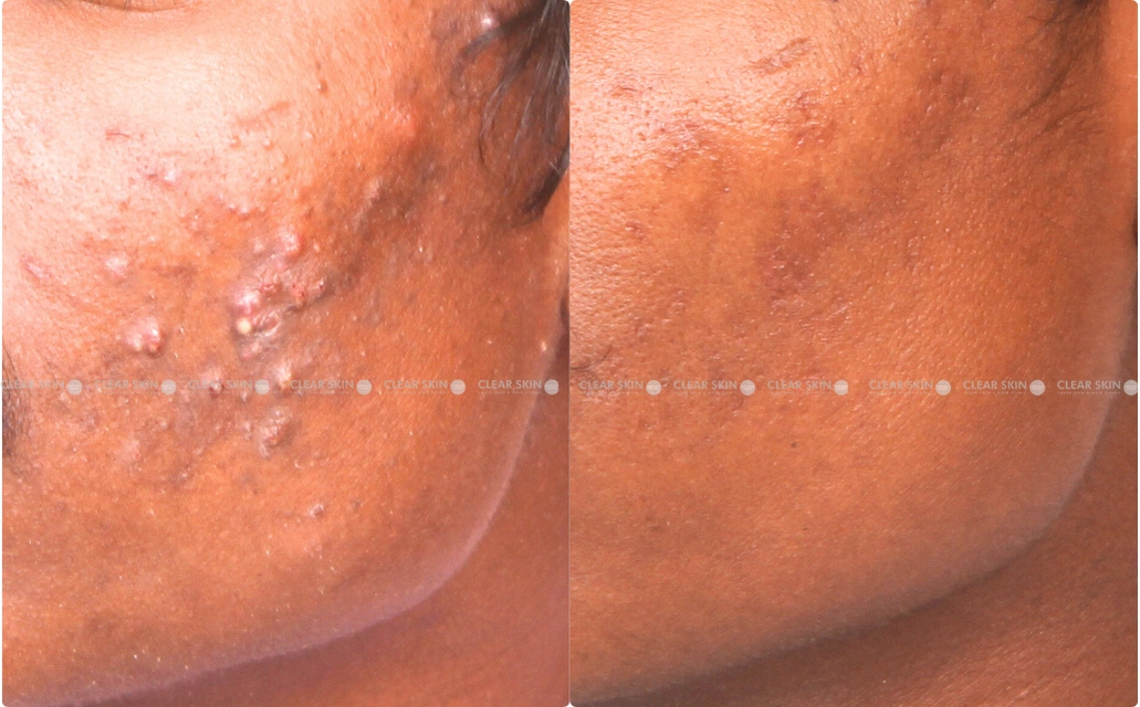 Acne Results 5 Sessions 6 Months Clear Skin Pune