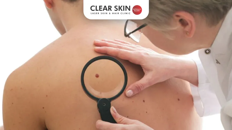 All You Need To Know About Moles Clear Skin Pune