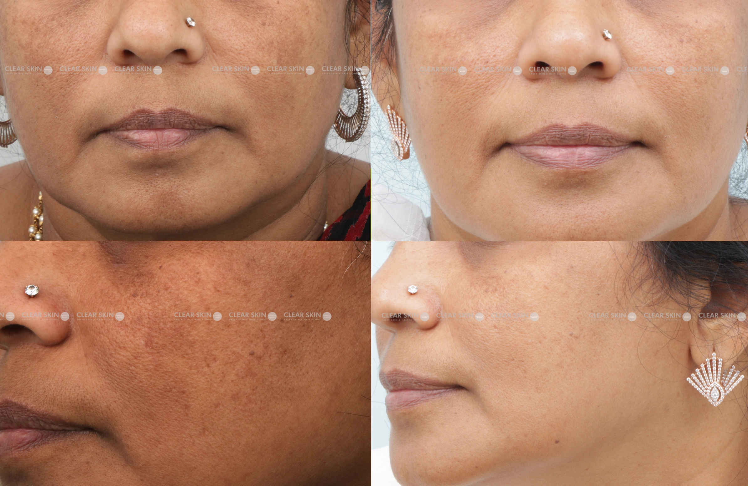 Anti Aging Results 4 Months Timeline 5 Sessions Clear Skin Pune