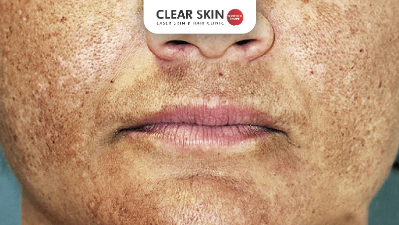 Best-Melasma-Treatment-for-Face-clear-skin-pune Best Melasma Treatment for Face clear skin pune