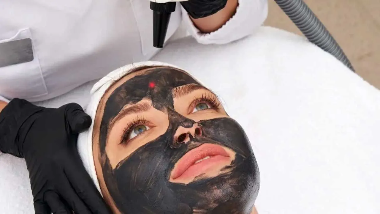 Carbon-Peel-Treatment Carbon Peel Treatment