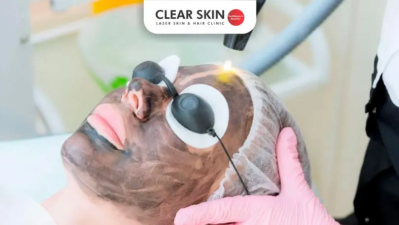 Carbon laser peel for acne Is it effective for acne Carbon laser peel for acne Is it effective for acne?