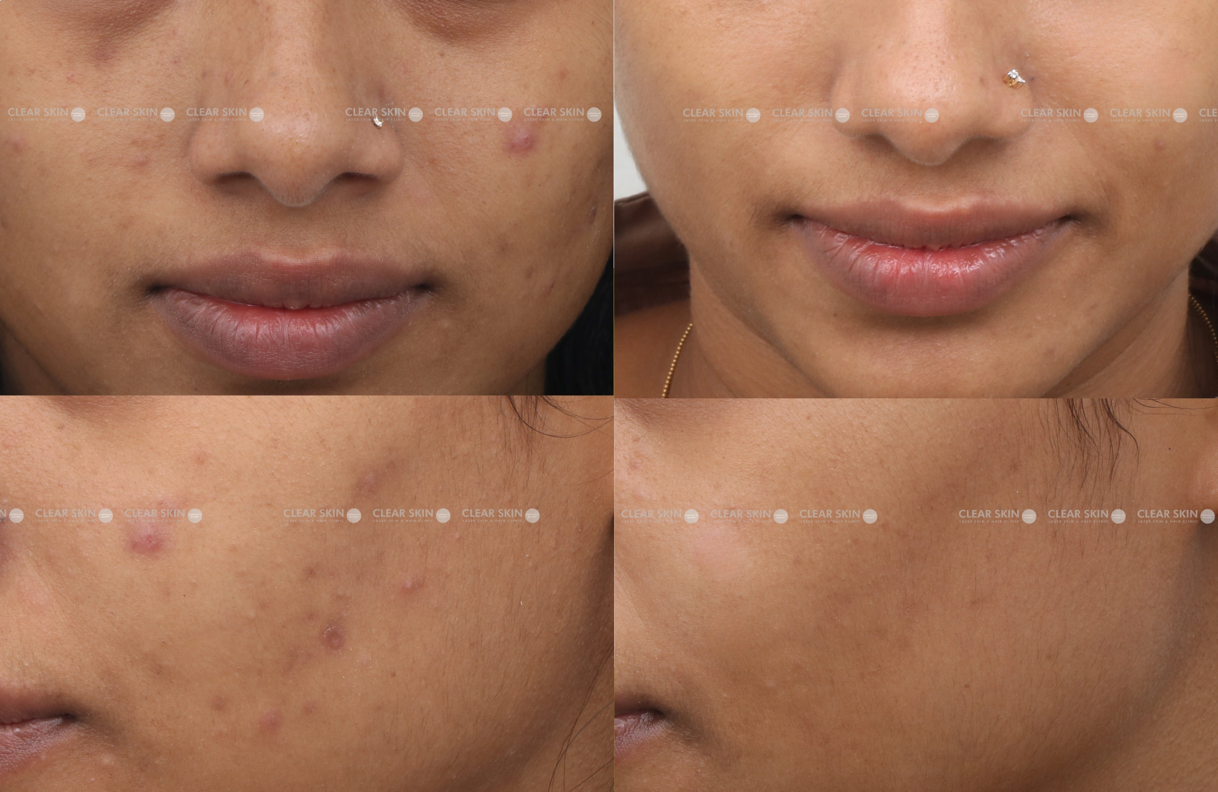 Chicken Pox Scar Results 6 Months Timeline 7 Sessions Clear Skin Pune