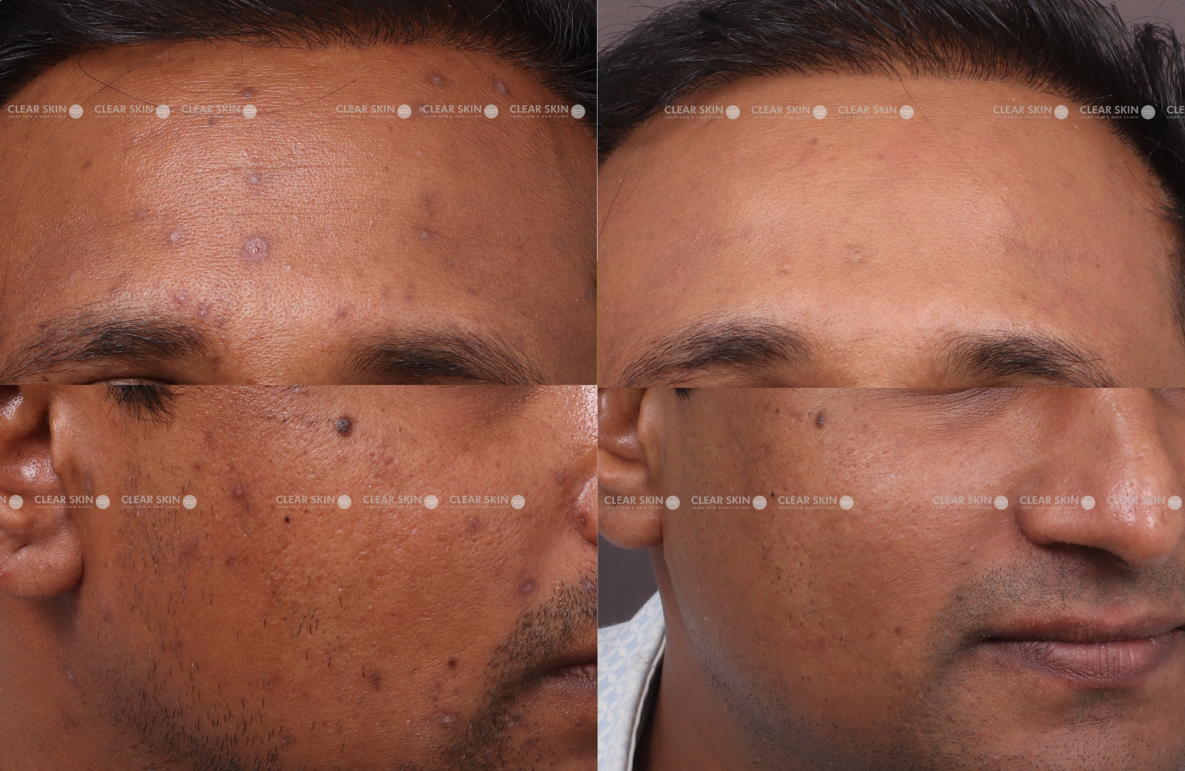 Chicken Pox Scar Results 5 Months Timeline 5 Sessions Clear Skin Pune