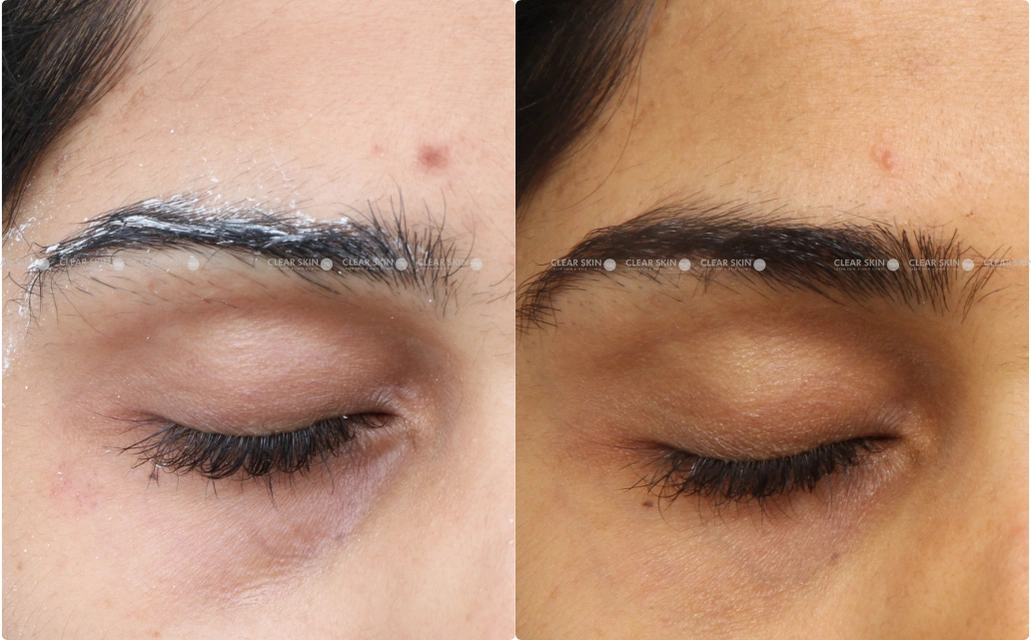 Darkcircles Results 4 Sessions 5 Months ClearSkin Pune