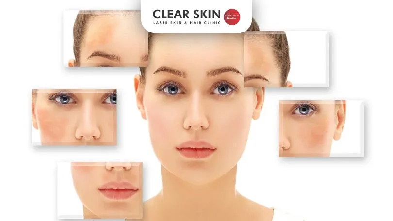 Different-Types-of-Melasma-and-How-to-Treat-Them-Clear-Skin-Pune Different-Types-of-Melasma-and-How-to-Treat-Them-Clear-Skin-Pune