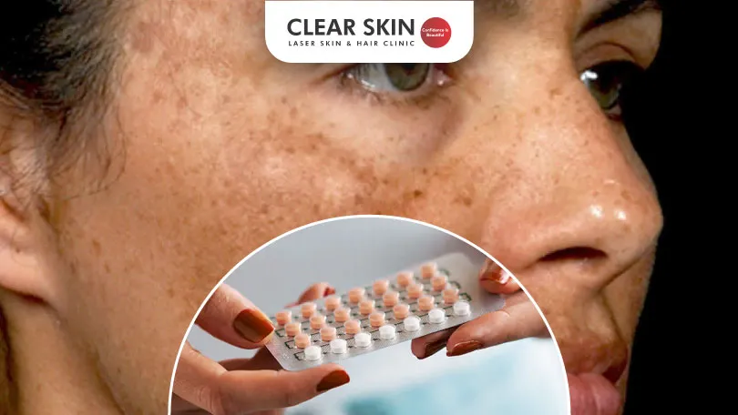 Do Birth Control Pills Cause Melasma Clear Skin Pune