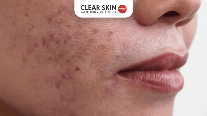 Does Laser Hair Removal Work  for Hyperpigmentation 