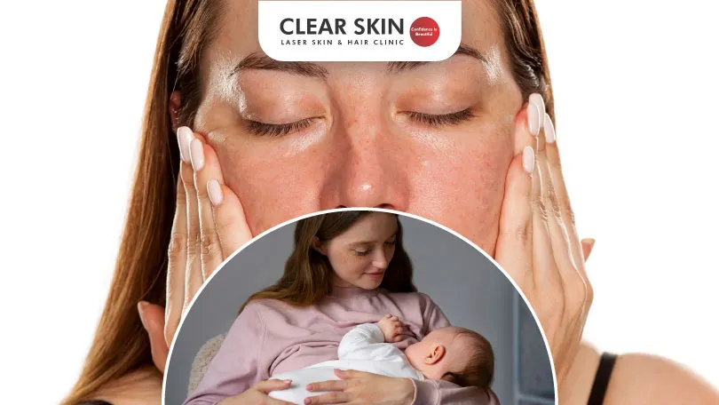 Does Melasma Go After Breastfeeding?