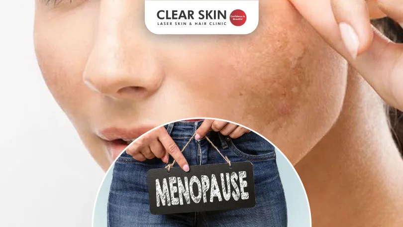 Does Melasma Go Away After Menopause