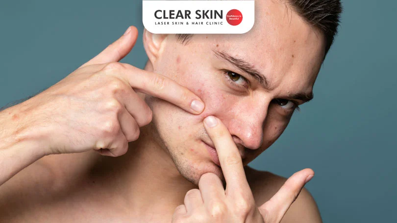 Does masturbation cause Acne